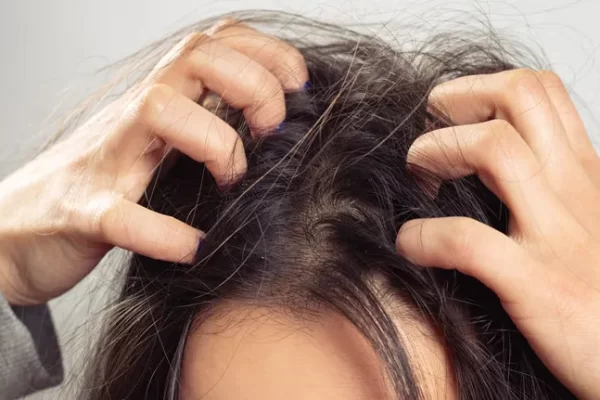 5 ways to treat dry scalp Effectively reduces itching and inflammation.